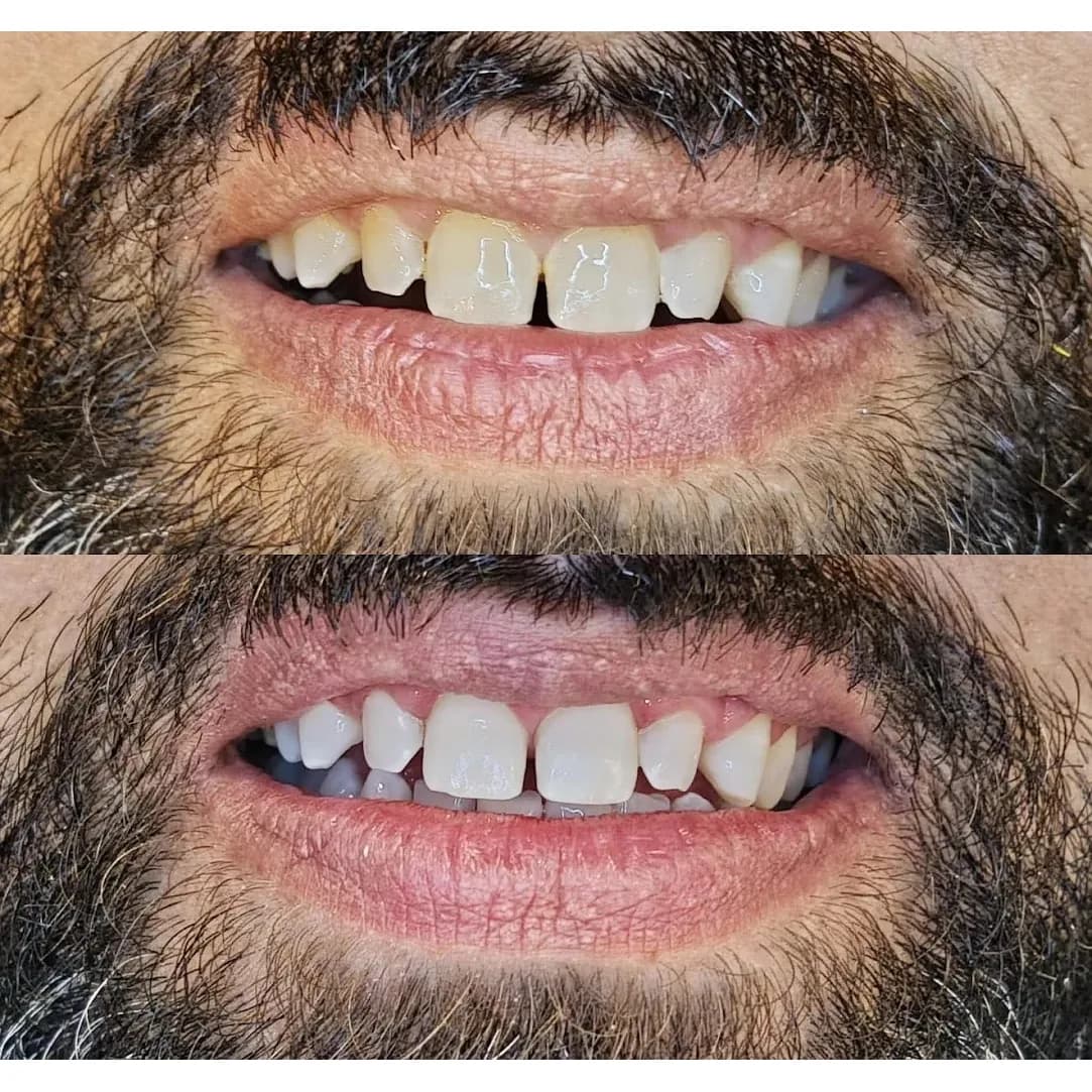 Before and after view of scaling, polishing and teeth whitening carried out at Dr Hashim & Associates