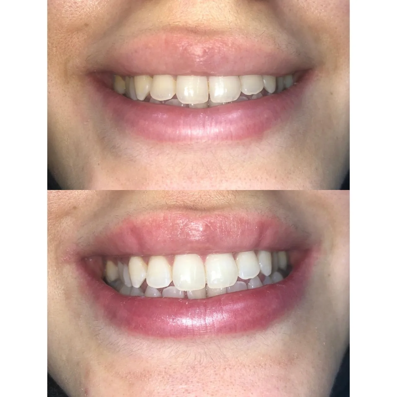Before and after view of teeth whitening carried out at Dr Hashim & Associates