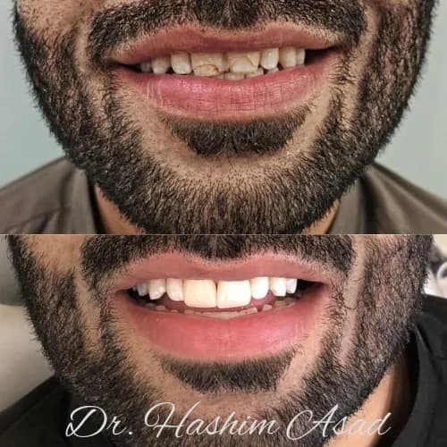 Before and after view of zirconia veneers carried out at Dr Hashim & Associates