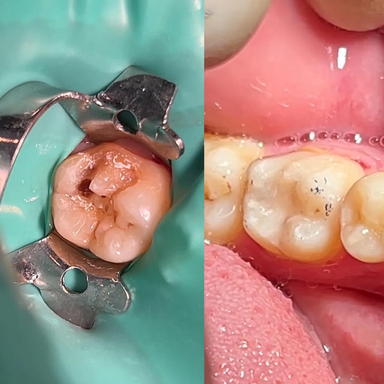 Before and after view of a composite filling carried out at Dr Hashim & Associates