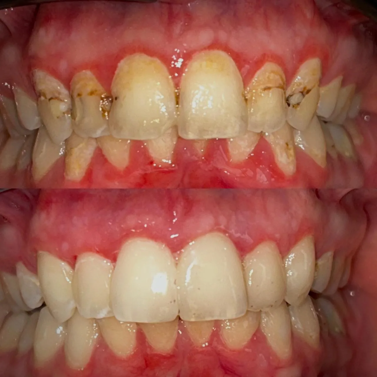 Before and after view of composite fillings carried out at Dr Hashim & Associates