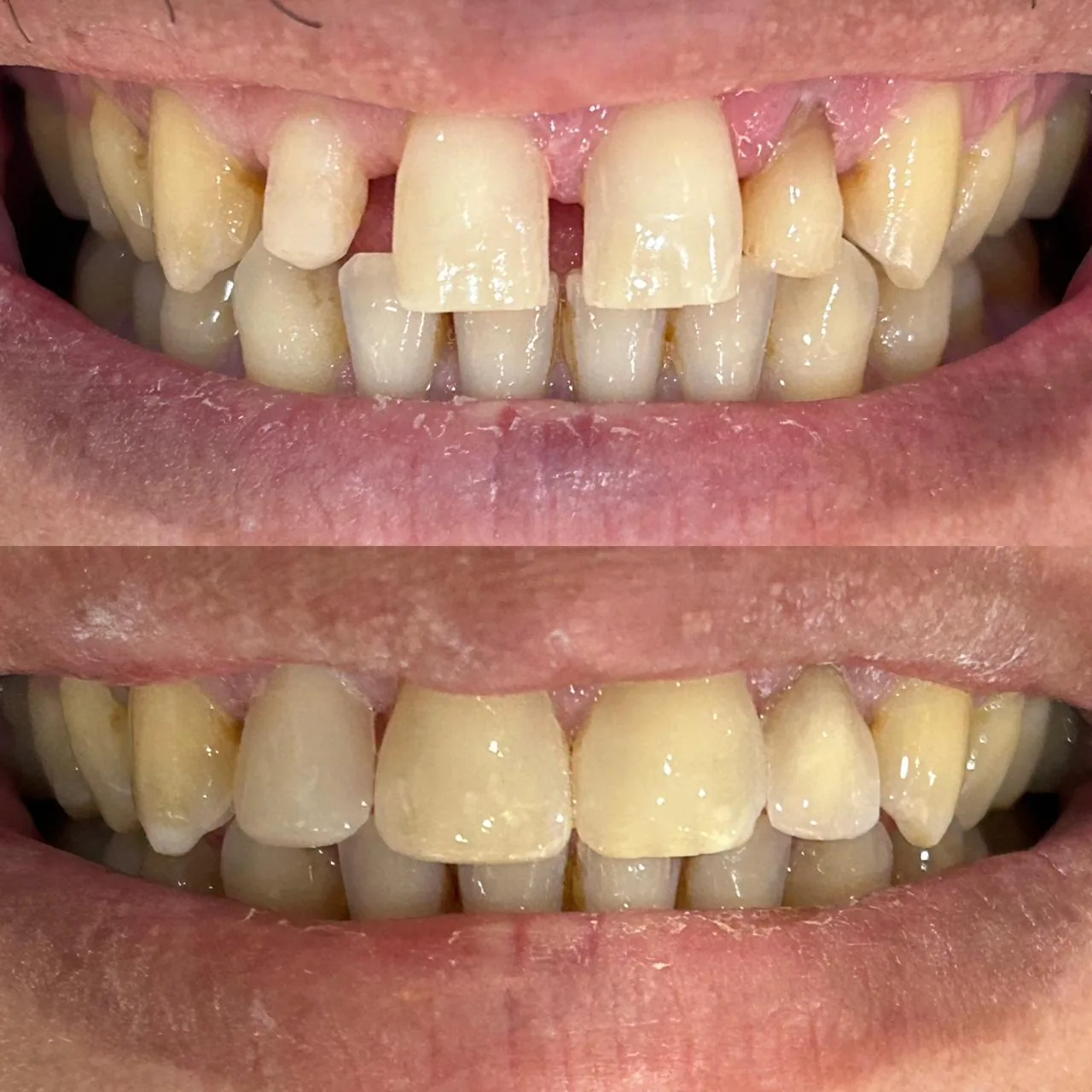 Before and after view of composite veneers carried out at Dr Hashim & Associates